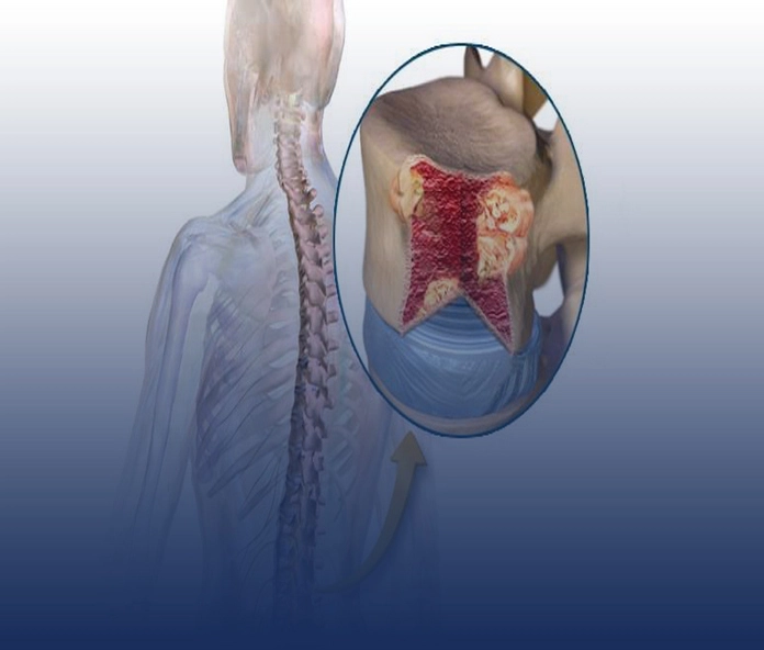 Bone Marrow Transplant
